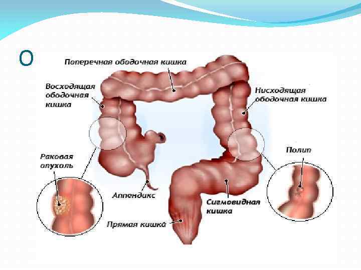 Опухоли толстого кишечника 