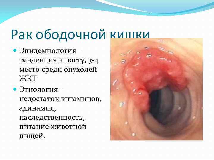 Рак ободочной кишки Эпидемиология – тенденция к росту, 3 -4 место среди опухолей ЖКТ