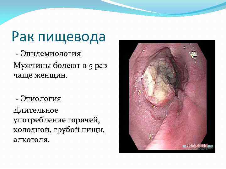 Рак пищевода - Эпидемиология Мужчины болеют в 5 раз чаще женщин. - Этиология Длительное