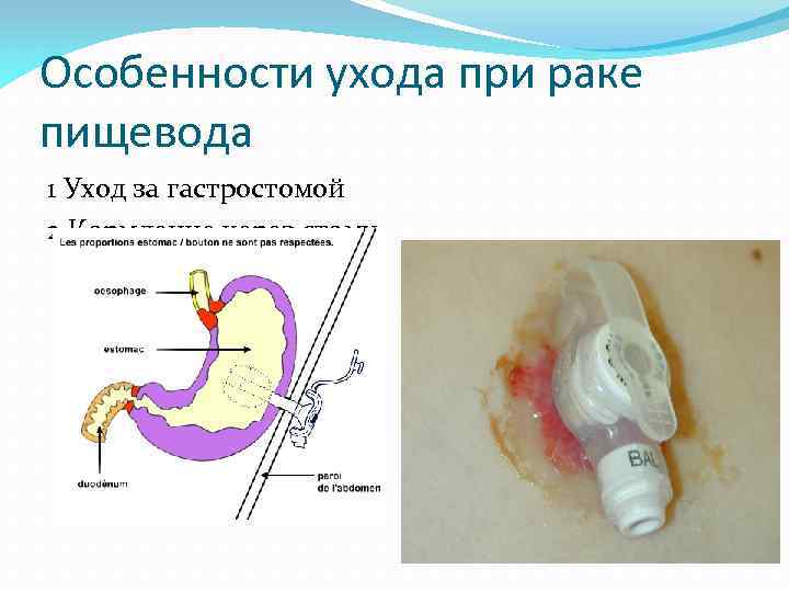Особенности ухода при раке пищевода 1 Уход за гастростомой 2 Кормление через стому 