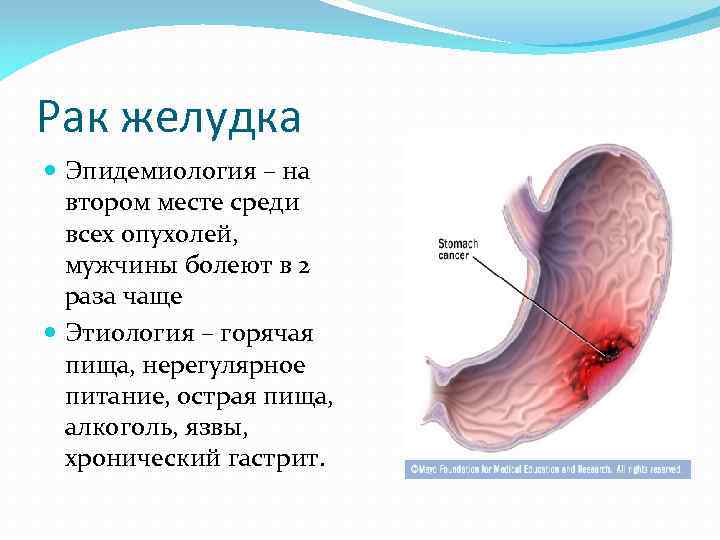 Рак желудка Эпидемиология – на втором месте среди всех опухолей, мужчины болеют в 2