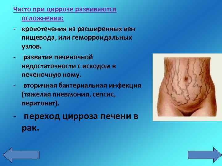 Часто при циррозе развиваются осложнения: - кровотечения из расширенных вен пищевода, или геморроидальных узлов.