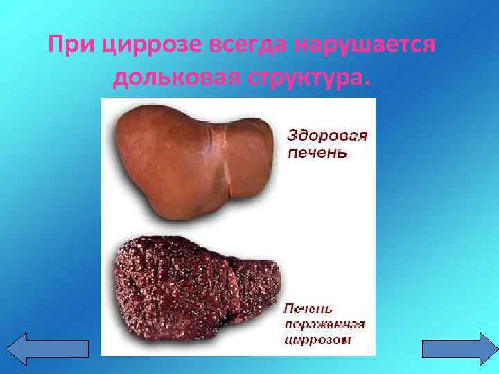 При циррозе всегда нарушается дольковая структура. 