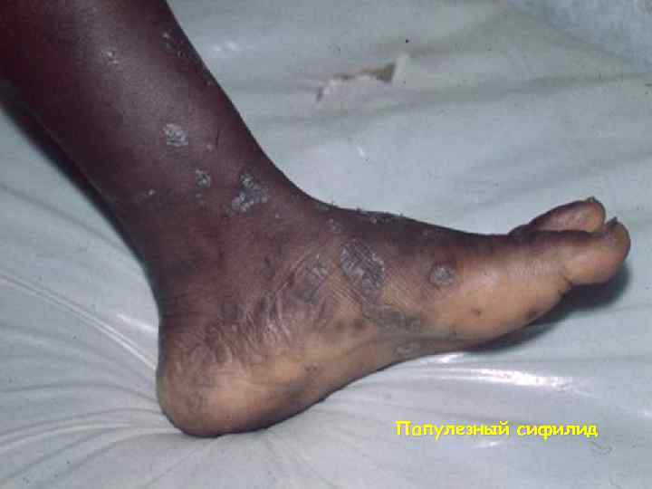 Папулезный сифилид 