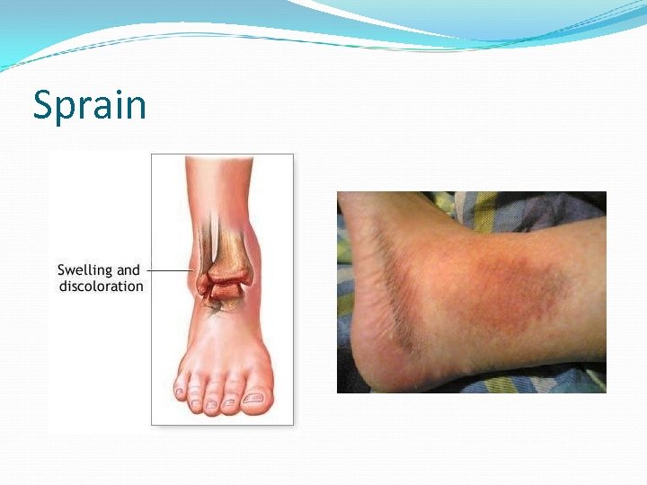 Sprain 