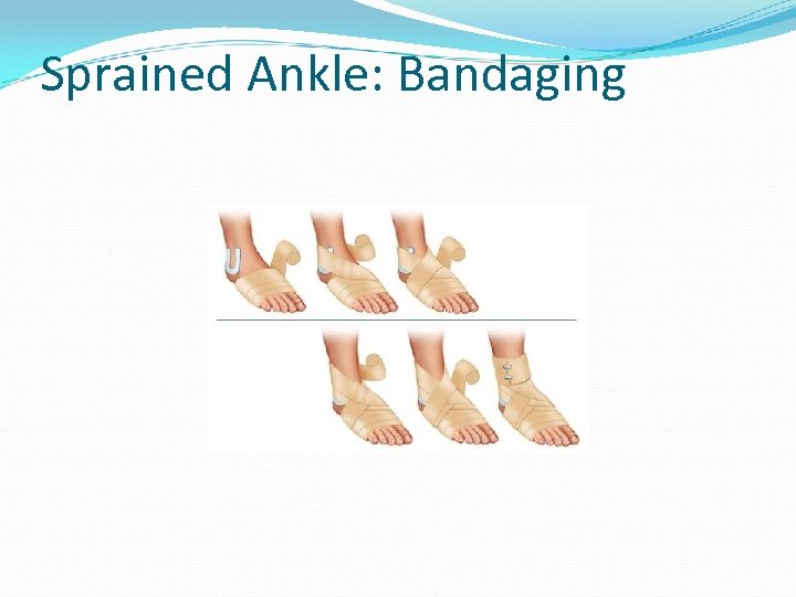 Sprained Ankle: Bandaging 