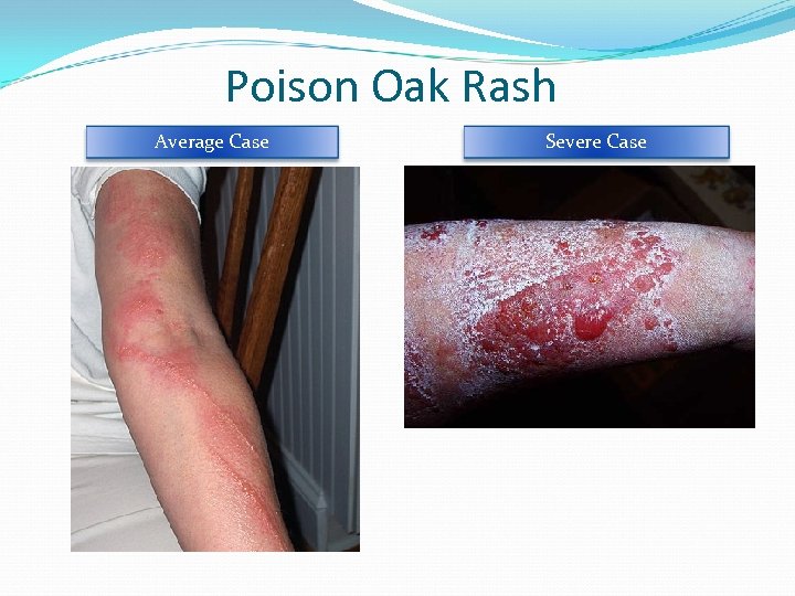 Poison Oak Rash Average Case Severe Case 