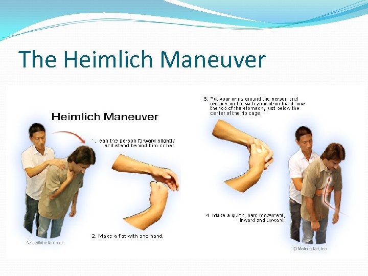 The Heimlich Maneuver 