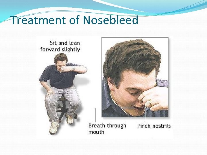 Treatment of Nosebleed 