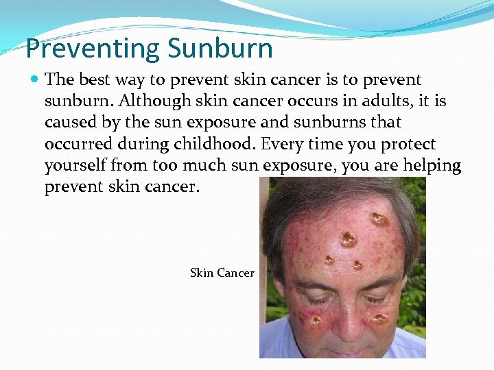 Preventing Sunburn The best way to prevent skin cancer is to prevent sunburn. Although