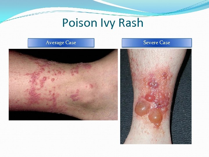 Poison Ivy Rash Average Case Severe Case 