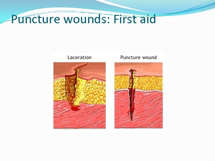 Puncture wounds: First aid 