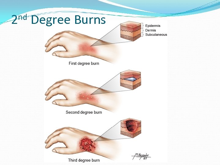 2 nd Degree Burns 