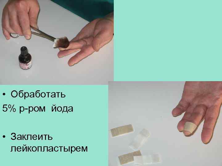  • Обработать 5% р-ром йода • Заклеить лейкопластырем 