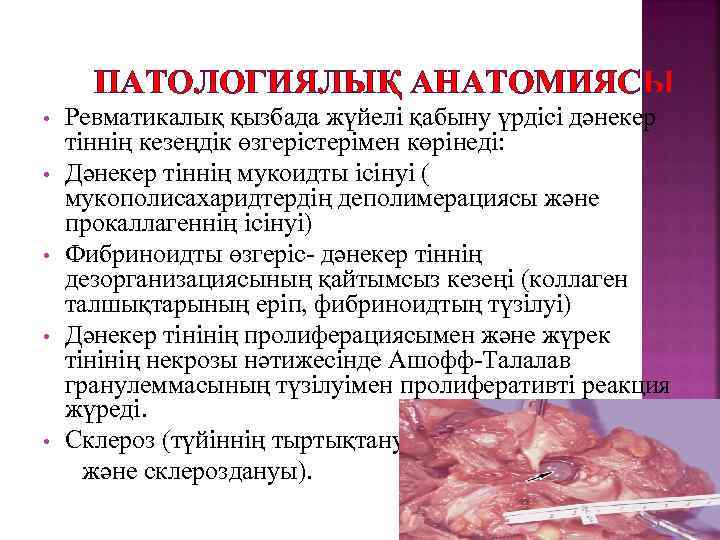 ПАТОЛОГИЯЛЫҚ АНАТОМИЯСЫ Ревматикалық қызбада жүйелі қабыну үрдісі дәнекер тіннің кезеңдік өзгерістерімен көрінеді: • Дәнекер