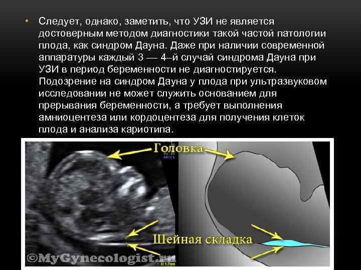  • Следует, однако, заметить, что УЗИ не является достоверным методом диагностики такой частой