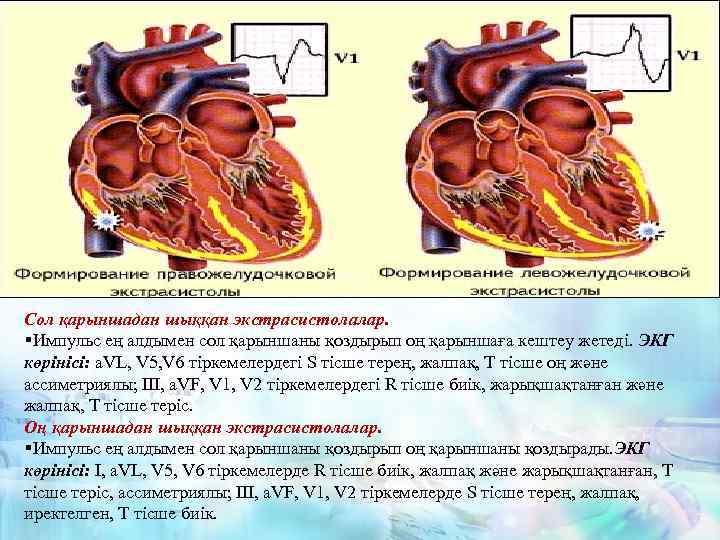 Сол қарыншадан шыққан экстрасистолалар. §Импульс ең алдымен сол қарыншаны қоздырып оң қарыншаға кештеу жетеді.