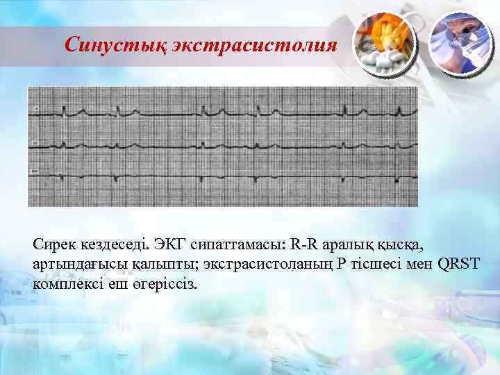 Синустық экстрасистолия Сирек кездеседі. ЭКГ сипаттамасы: R-R аралық қысқа, артындағысы қалыпты; экстрасистоланың Р тісшесі