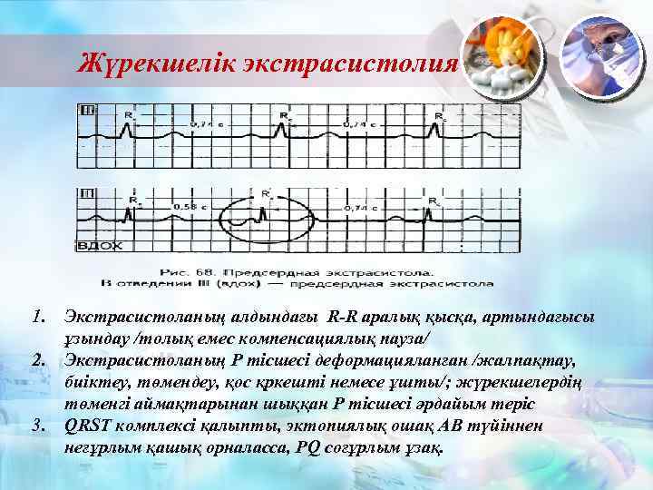 Жүрекшелік экстрасистолия 1. 2. 3. Экстрасистоланың алдындағы R-R аралық қысқа, артындағысы ұзындау /толық емес