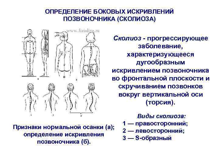 ОПРЕДЕЛЕНИЕ БОКОВЫХ ИСКРИВЛЕНИЙ ПОЗВОНОЧНИКА (СКОЛИОЗА) Сколиоз - прогрессирующее заболевание, характеризующееся дугообразным искривлением позвоночника во