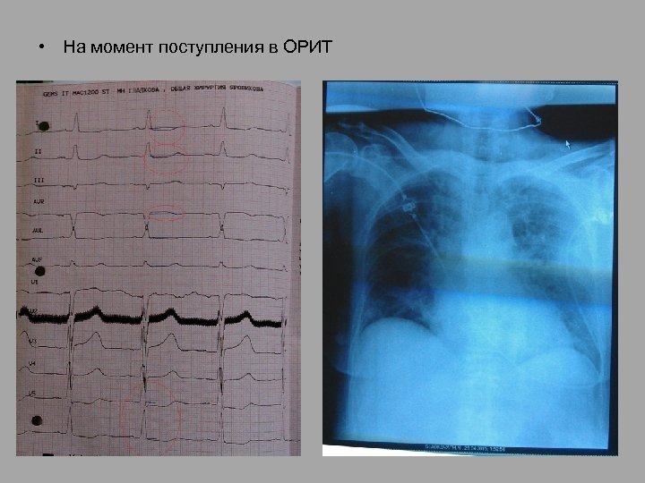  • На момент поступления в ОРИТ 