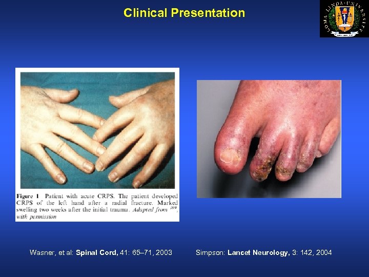 Clinical Presentation Wasner, et al: Spinal Cord, 41: 65– 71, 2003 Simpson: Lancet Neurology,