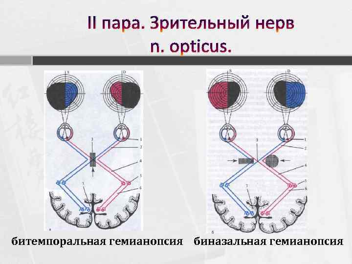 II пара. Зрительный нерв n. opticus. битемпоральная гемианопсия биназальная гемианопсия 