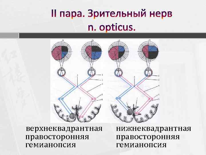 II пара. Зрительный нерв n. opticus. верхнеквадрантная правосторонняя гемианопсия нижнеквадрантная правосторонняя гемианопсия 