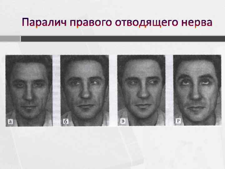 Паралич правого отводящего нерва 