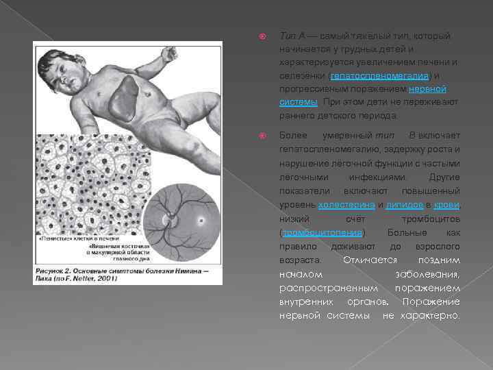  Тип А — самый тяжёлый тип, который начинается у грудных детей и характеризуется