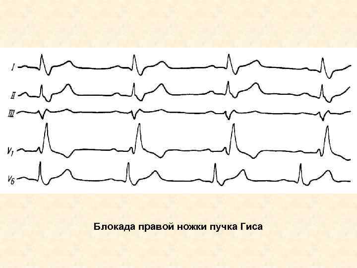 Блокада правой ножки пучка Гиса 