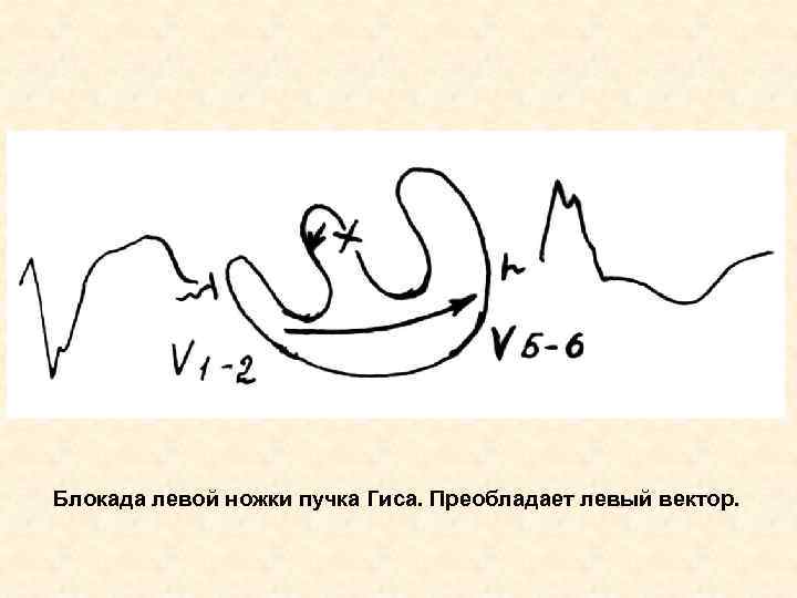 Блокада левой ножки пучка Гиса. Преобладает левый вектор. 