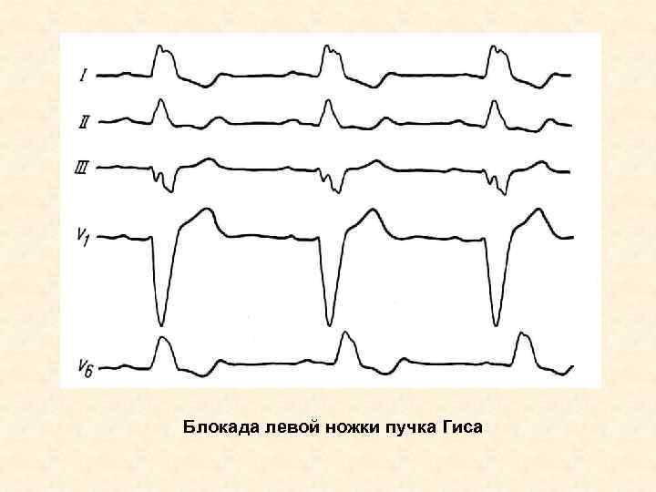 Блокада левой ножки пучка Гиса 