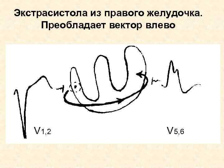 Экстрасистола из правого желудочка. Преобладает вектор влево V 1, 2 V 5, 6 