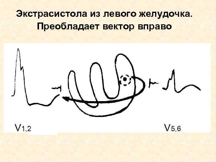 Экстрасистола из левого желудочка. Преобладает вектор вправо V 1, 2 V 5, 6 