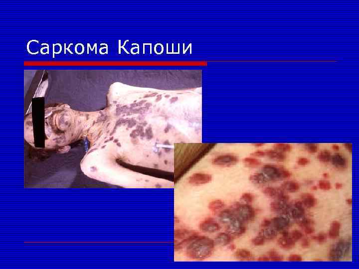 Саркома Капоши 