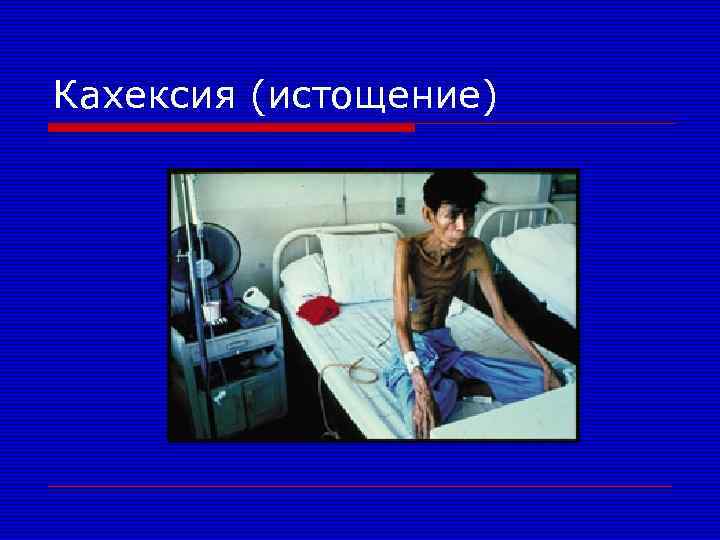 Кахексия (истощение) 