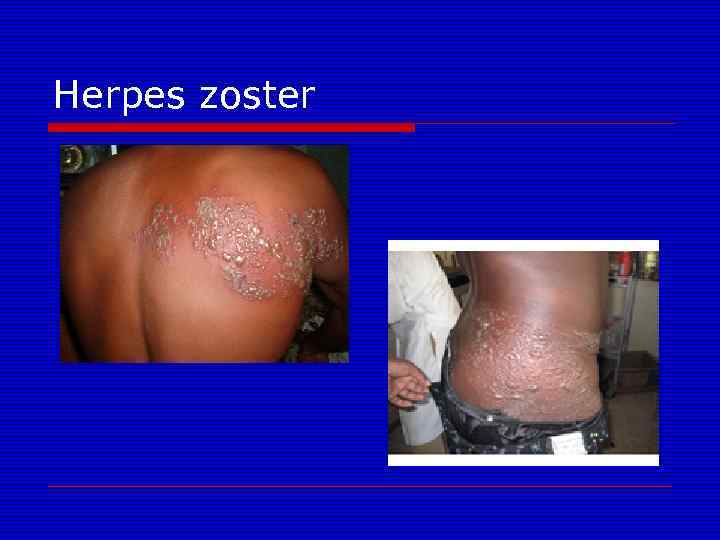 Herpes zoster 