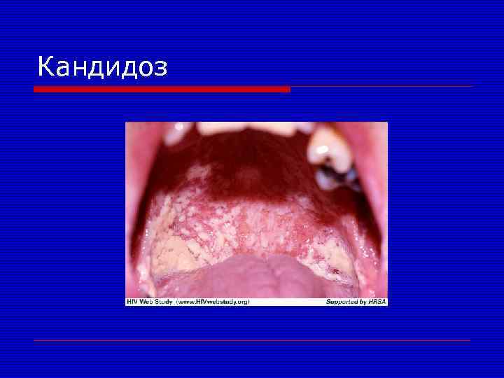 Кандидоз 