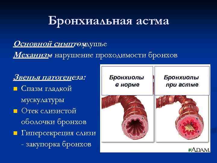 Бронхиальная астма Основной симптом – удушье Механизм нарушение проходимости бронхов – Звенья патогенеза: Спазм