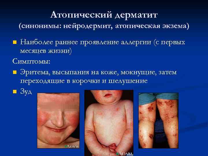 Атопический дерматит (синонимы: нейродермит, атопическая экзема) Наиболее раннее проявление аллергии (с первых месяцев жизни)