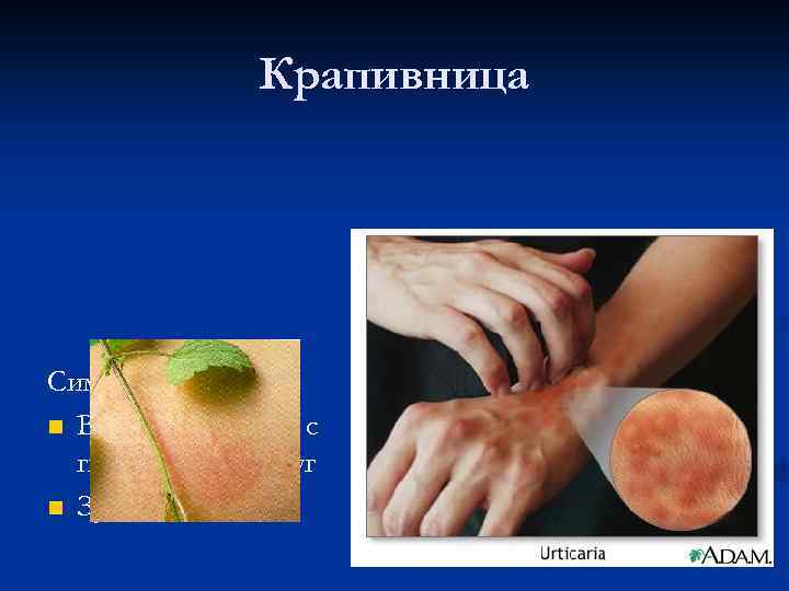 Крапивница Симптомы: Волдыри на коже с гиперемией вокруг Зуд 