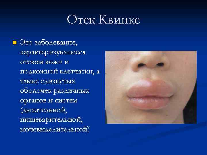 Отек Квинке Это заболевание, характеризующееся отеком кожи и подкожной клетчатки, а также слизистых оболочек