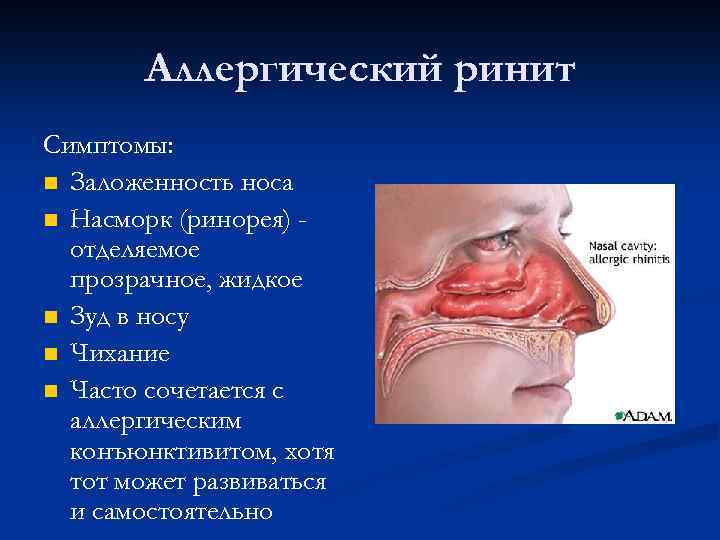 Аллергический ринит Симптомы: Заложенность носа Насморк (ринорея) отделяемое прозрачное, жидкое Зуд в носу Чихание