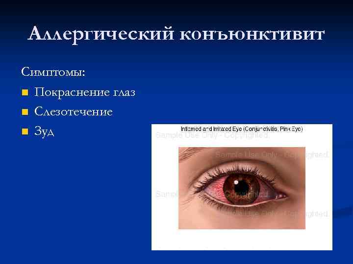 Аллергический конъюнктивит Симптомы: Покраснение глаз Слезотечение Зуд 