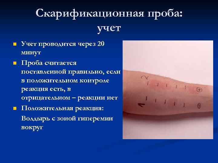 Скарификационная проба: учет Учет проводится через 20 минут Проба считается поставленной правильно, если в