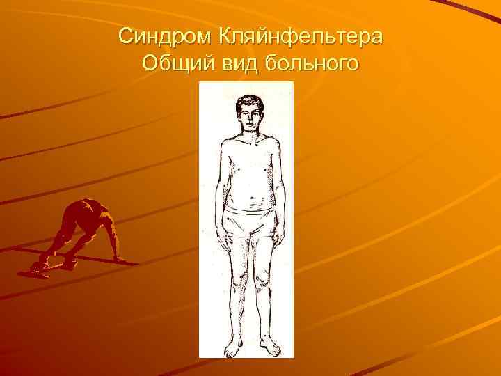 Синдром Кляйнфельтера Общий вид больного 