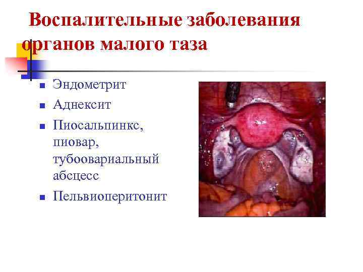  Воспалительные заболевания органов малого таза n n Эндометрит Аднексит Пиосальпинкс, пиовар, тубоовариальный абсцесс