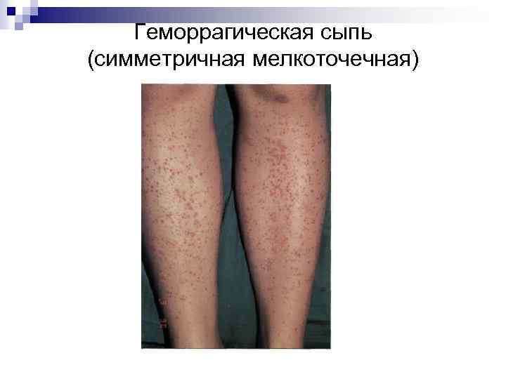 Геморрагическая сыпь (симметричная мелкоточечная) 