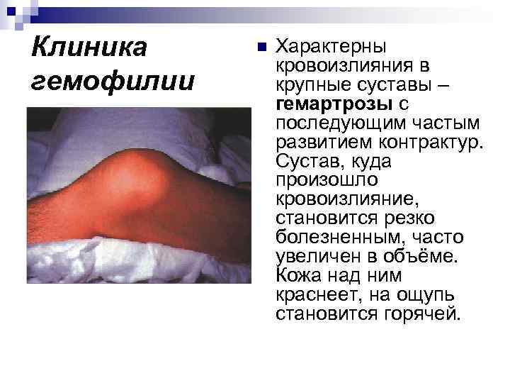 Клиника гемофилии n Характерны кровоизлияния в крупные суставы – гемартрозы с последующим частым развитием